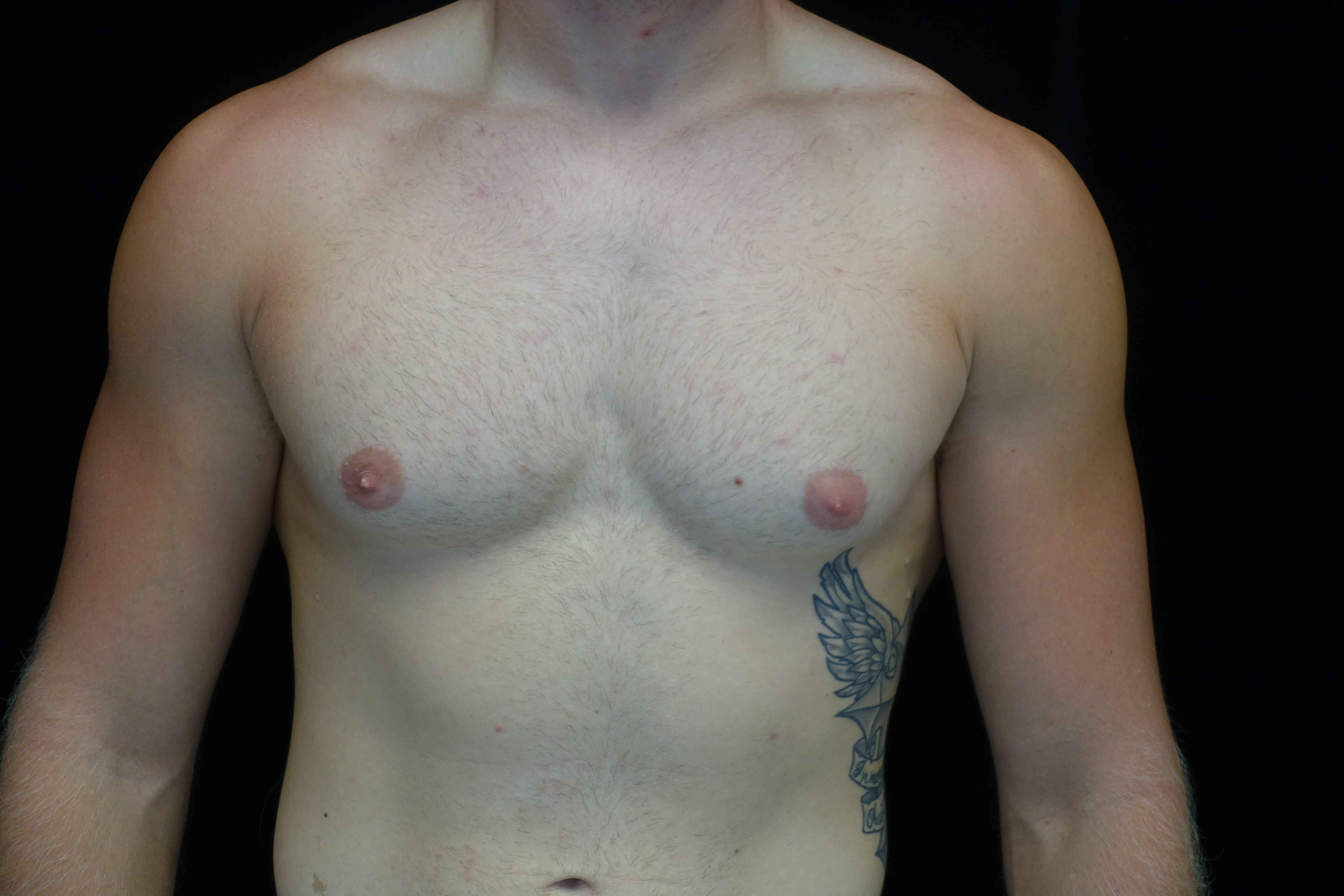 Gynecomastia Before & After Patient #14949