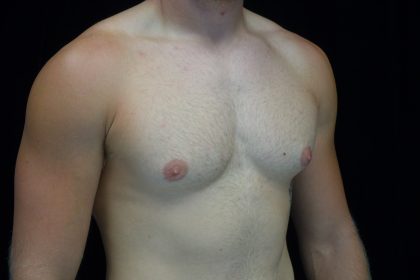 Gynecomastia Before & After Patient #14949
