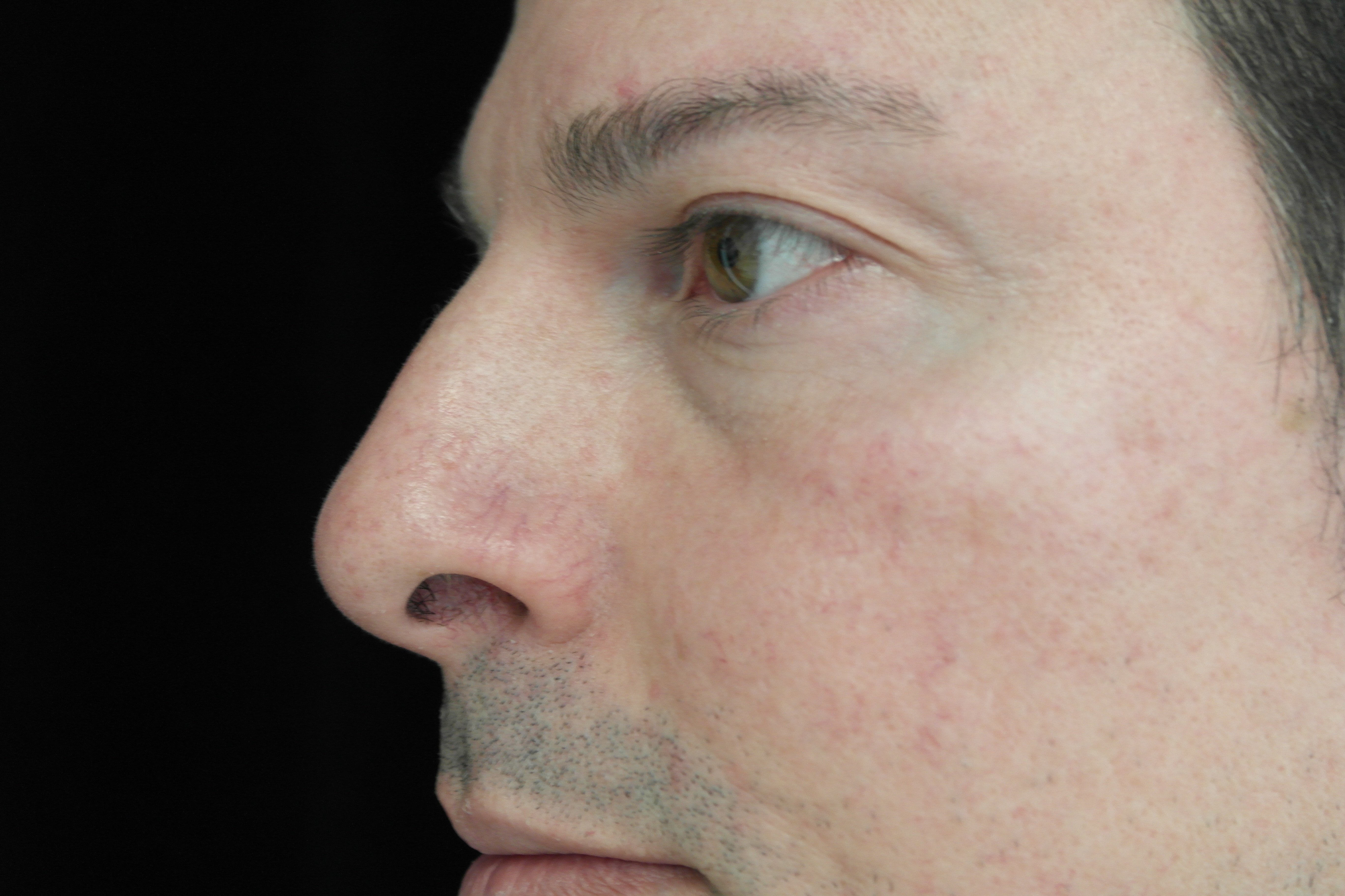 Intensive Pulse Light (IPL) Before & After Patient #14799
