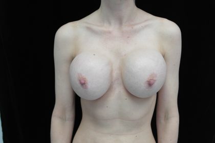 Breast Revision Before & After Patient #14665