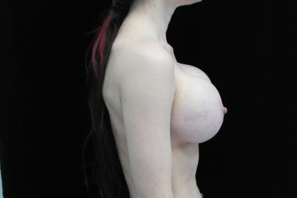 Breast Revision Before & After Patient #14665