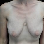 Breast Lift Before & After Patient #14396