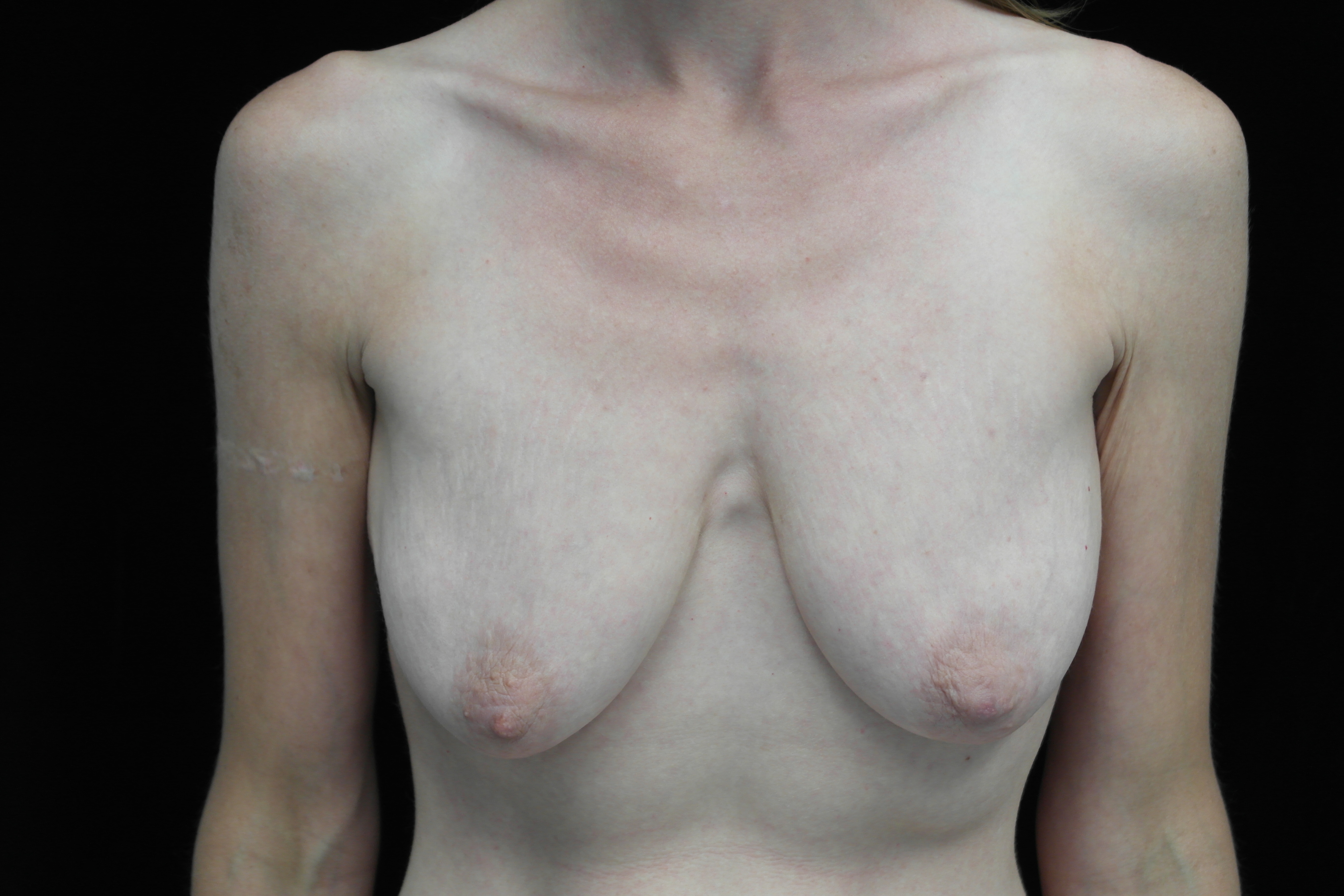 Breast Lift Before & After Patient #14396