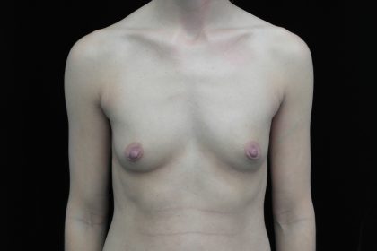 Breast Augmentation (Implants) Before & After Patient #14013