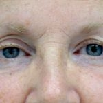 Blepharoplasty Before & After Patient #13899