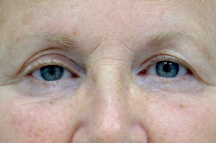 Blepharoplasty Before & After Patient #13899