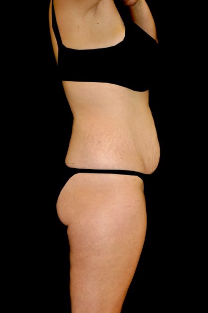 Tummy Tuck Before & After Patient #14938