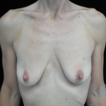 Breast Lift with Implants Before & After Patient #14507