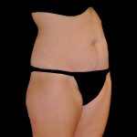 Tummy Tuck Before & After Patient #14938