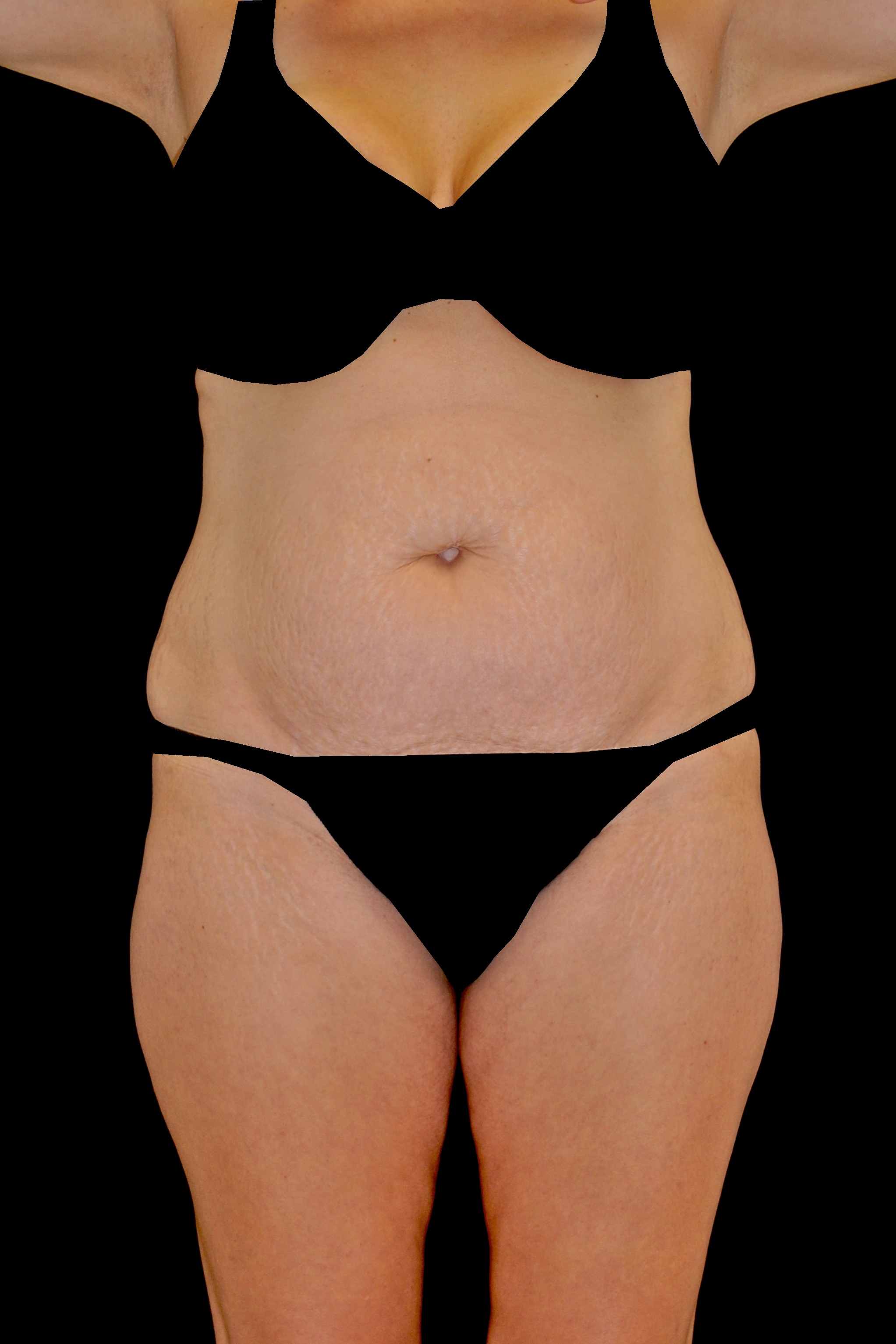 Tummy Tuck Before & After Patient #14938