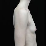 Breast Augmentation (Implants) Before & After Patient #14013