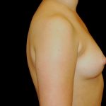 Breast Augmentation (Implants) Before & After Patient #14157