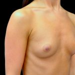 Breast Augmentation (Implants) Before & After Patient #14162