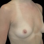 Breast Augmentation (Implants) Before & After Patient #14083