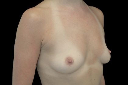 Breast Augmentation (Implants) Before & After Patient #14083