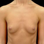 Breast Augmentation (Implants) Before & After Patient #14162