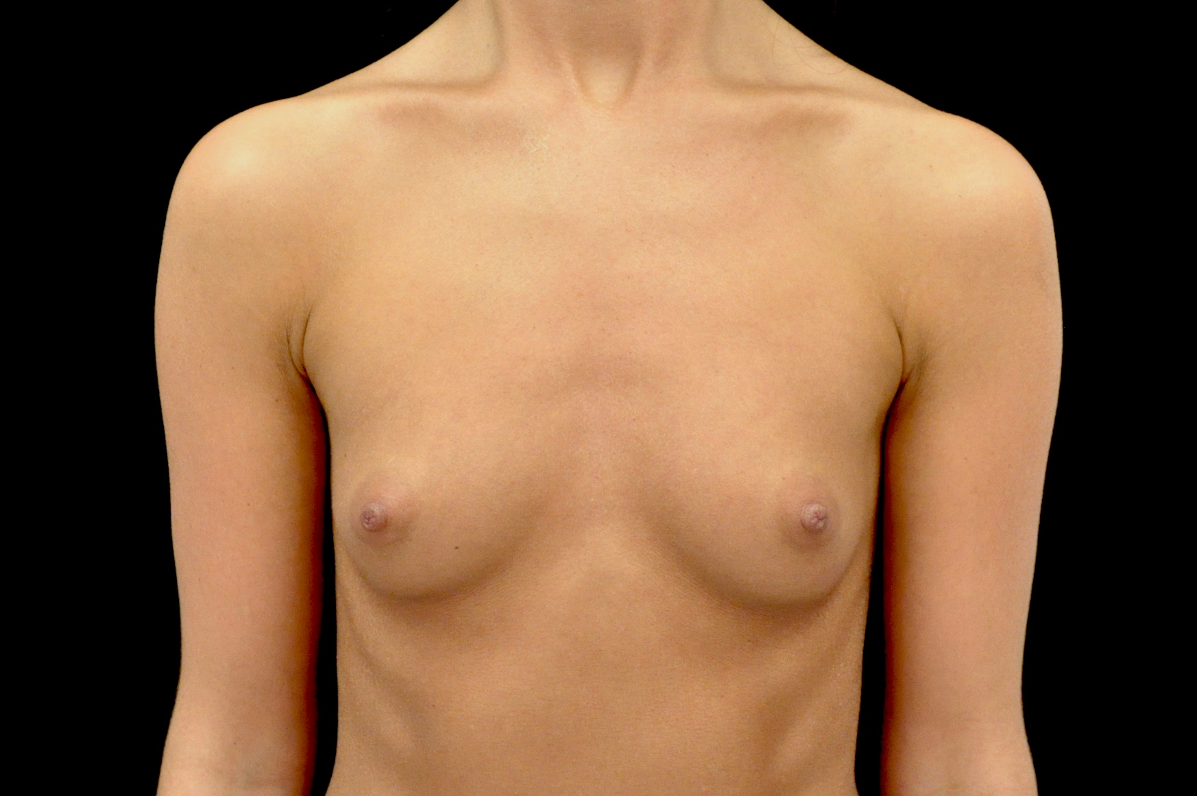 Breast Augmentation (Implants) Before & After Patient #14162