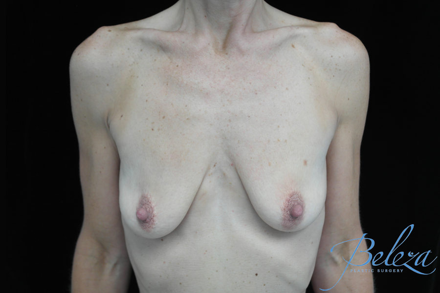 Breast Lift with Implants Before & After Patient #14507