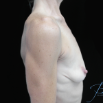 Breast Lift with Implants Before & After Patient #14507