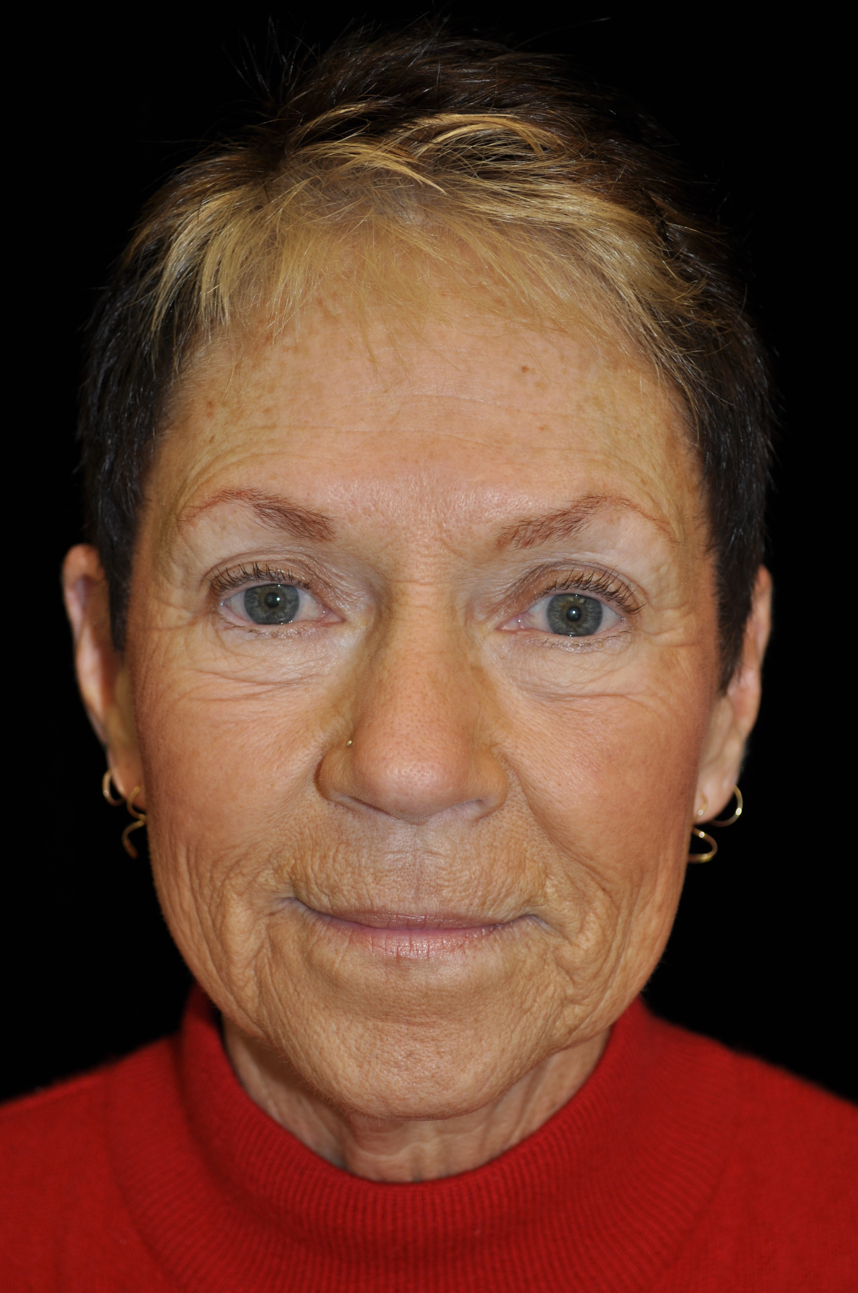 Liquid Facelift Before & After Patient #14841