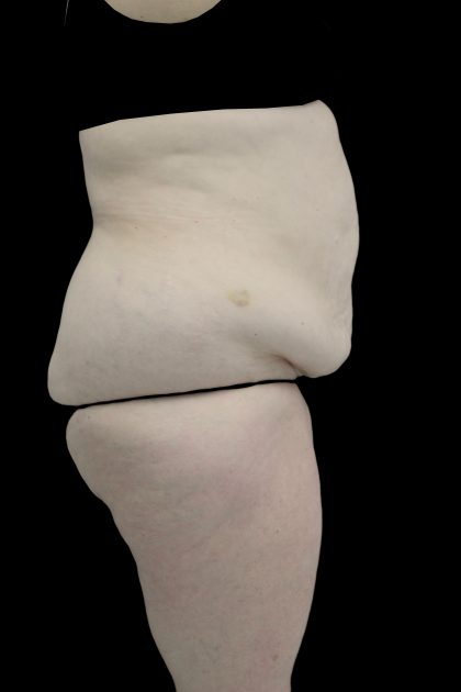Lipoabdominoplasty Before & After Patient #15078