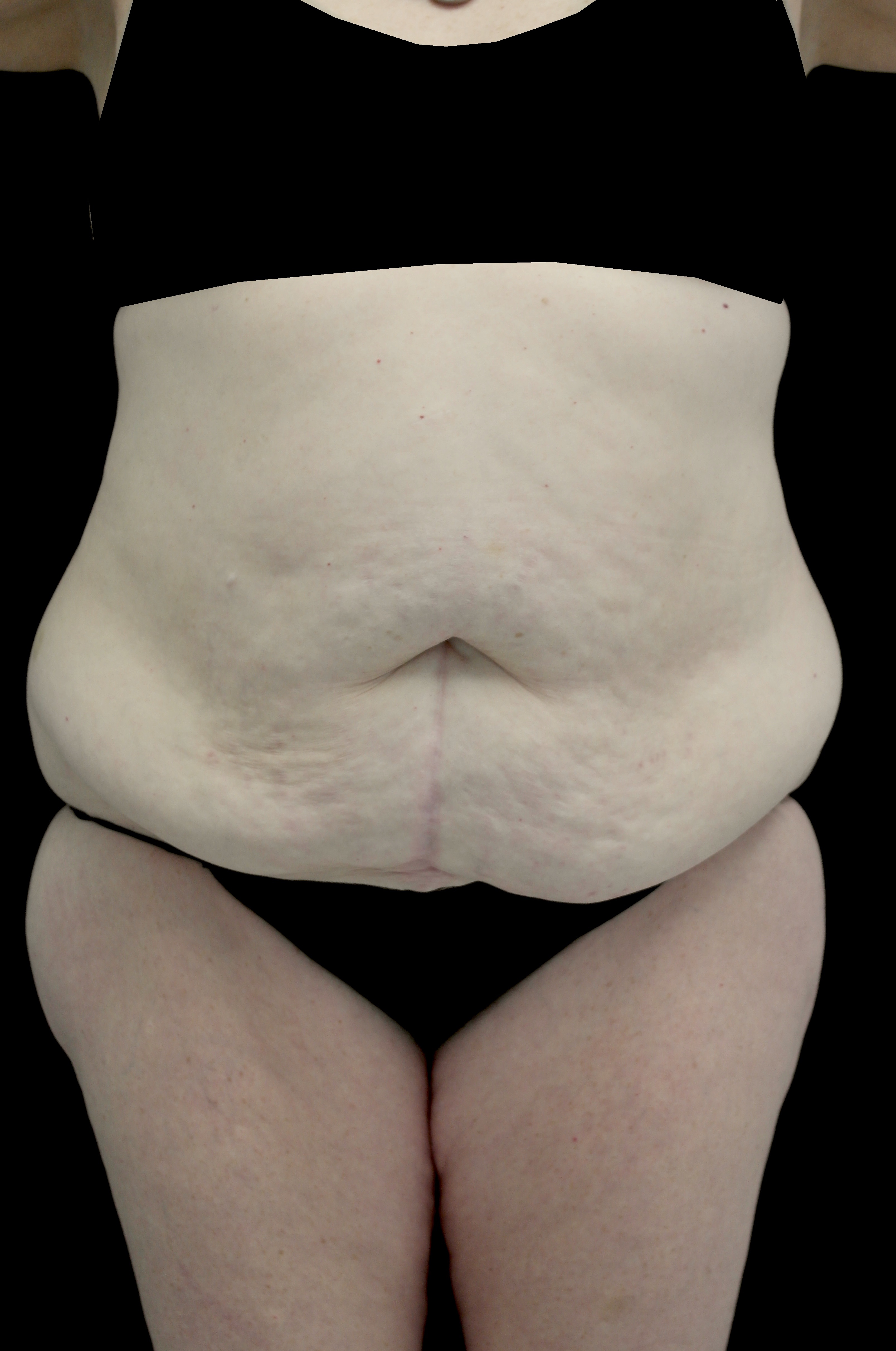 Lipoabdominoplasty Before & After Patient #15078