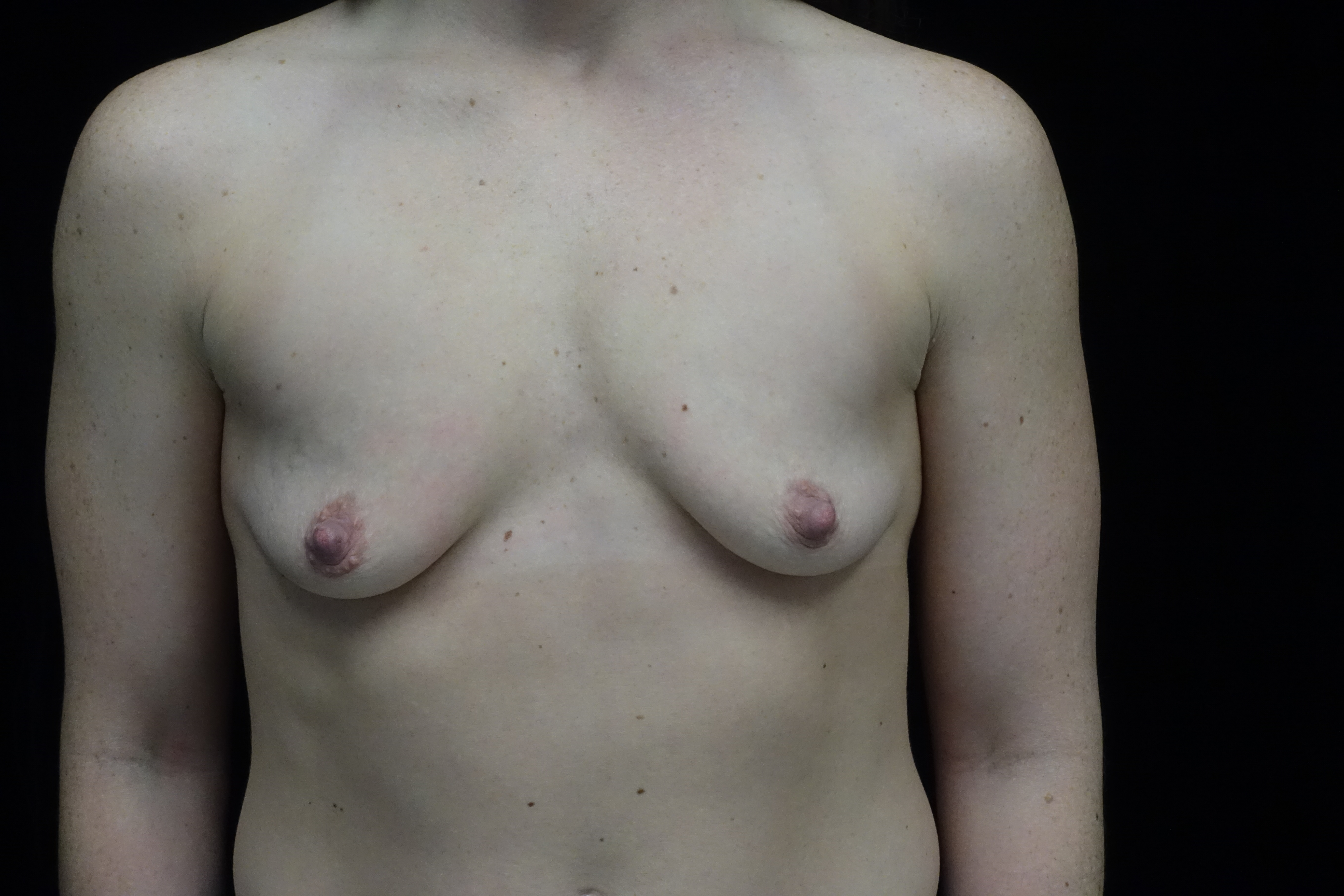 Breast Augmentation (Implants) Before & After Patient #14332