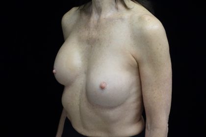 Breast Revision Before & After Patient #14719