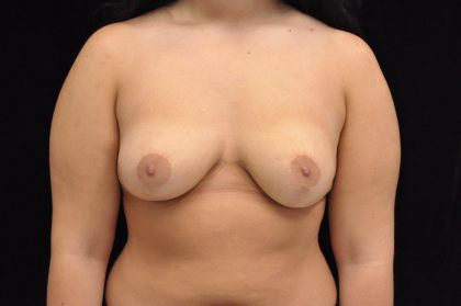Breast Reduction Before & After Patient #14623