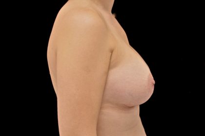 Breast Augmentation (Implants) Before & After Patient #14113