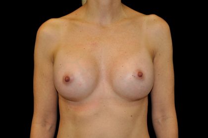 Breast Augmentation (Implants) Before & After Patient #14277
