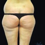 Buttock Augmentation Before & After Patient #14769