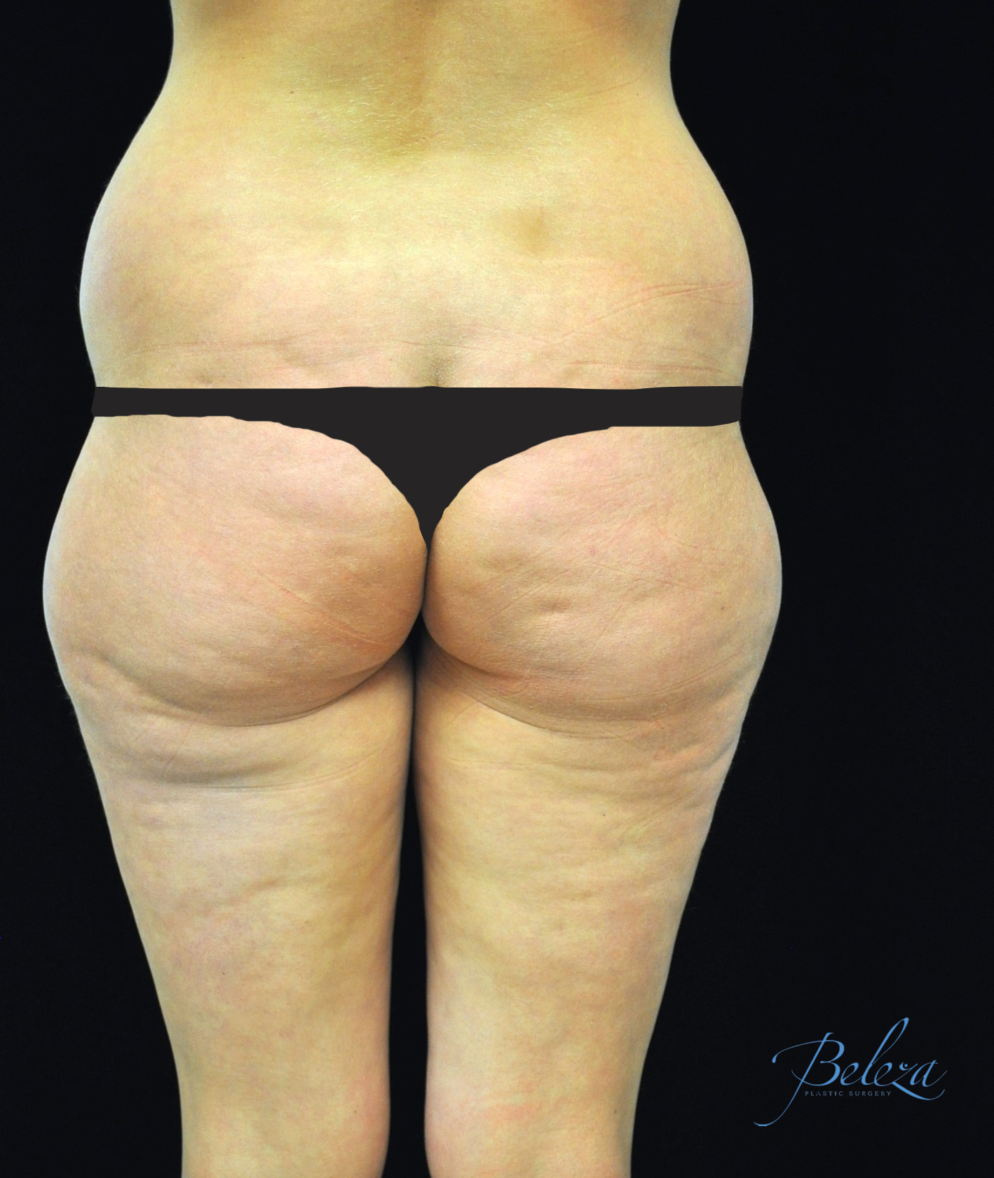 Buttock Augmentation Before & After Patient #14769