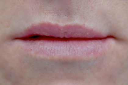 Lip Augmentation - Fillers Before & After Patient #14842