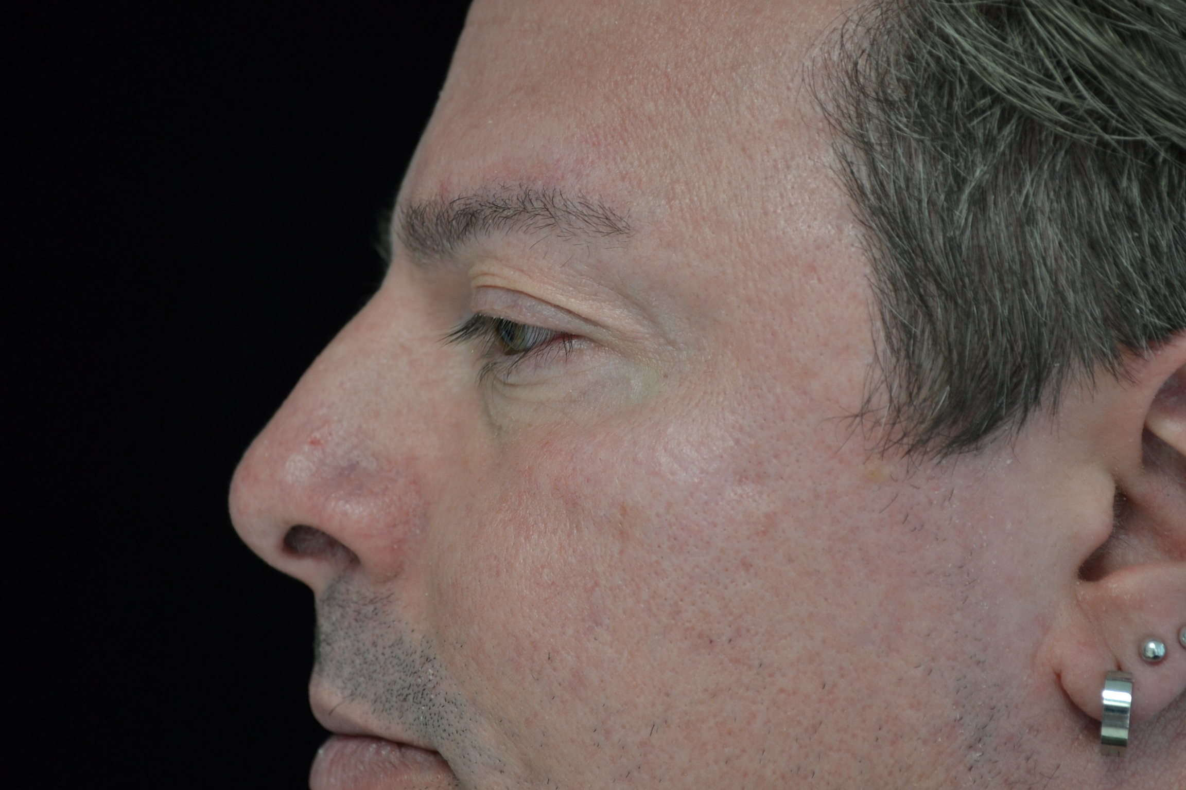 Intensive Pulse Light (IPL) Before & After Patient #14799