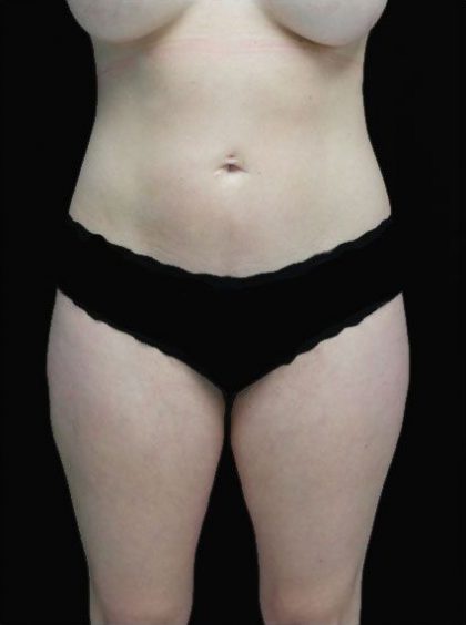 Liposuction Before & After Patient #15056