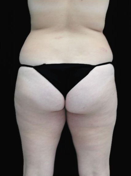 Liposuction Before & After Patient #15056