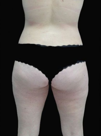 Liposuction Before & After Patient #15056