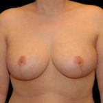 Breast Reduction Before & After Patient #14586
