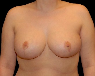 Breast Reduction Before & After Patient #14586