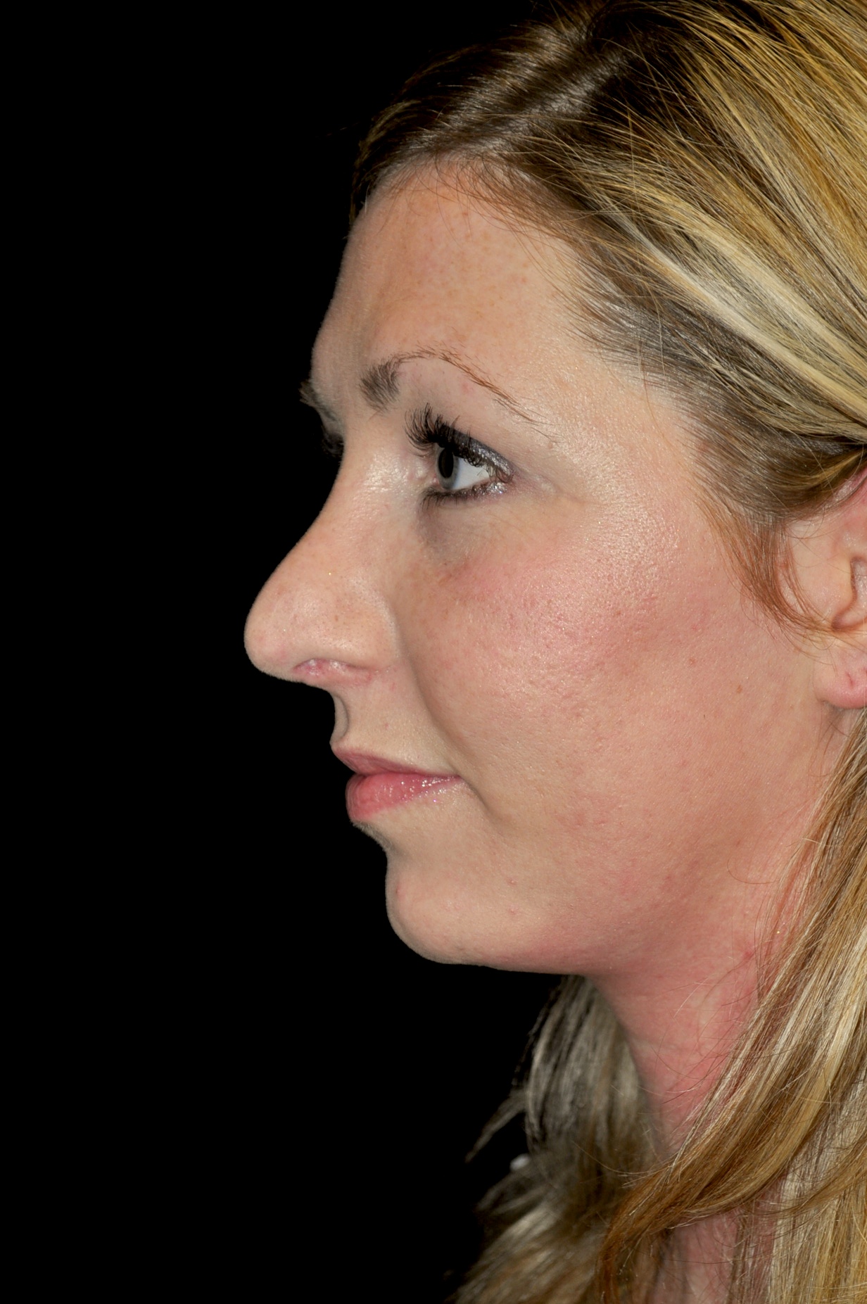 Chin Implants (Augmentation) Before & After Patient #14798