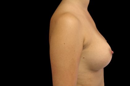Breast Augmentation (Implants) Before & After Patient #14157