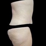 Lipoabdominoplasty Before & After Patient #15098