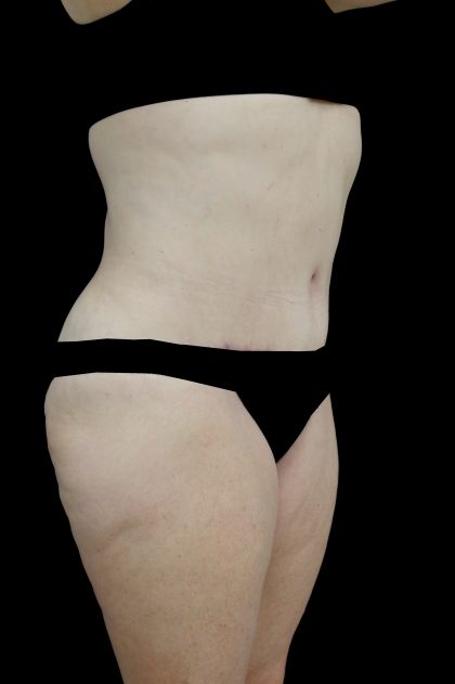 Lipoabdominoplasty Before & After Patient #15078