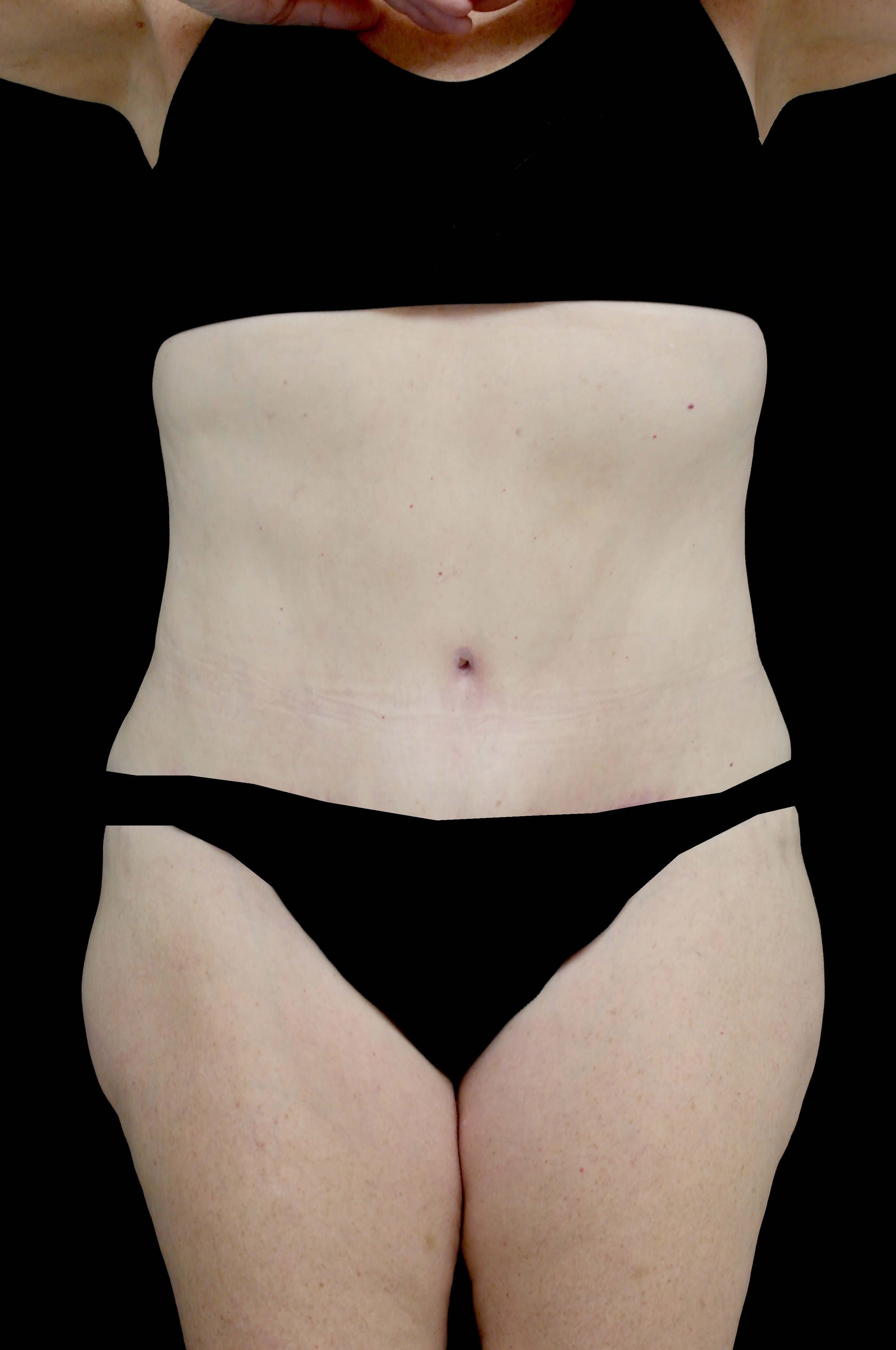 Lipoabdominoplasty Before & After Patient #15078