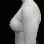 Breast Augmentation (Implants) Before & After Patient #14332