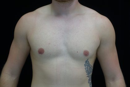 Gynecomastia Before & After Patient #14949