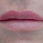 Lip Augmentation - Fillers Before & After Patient #14842