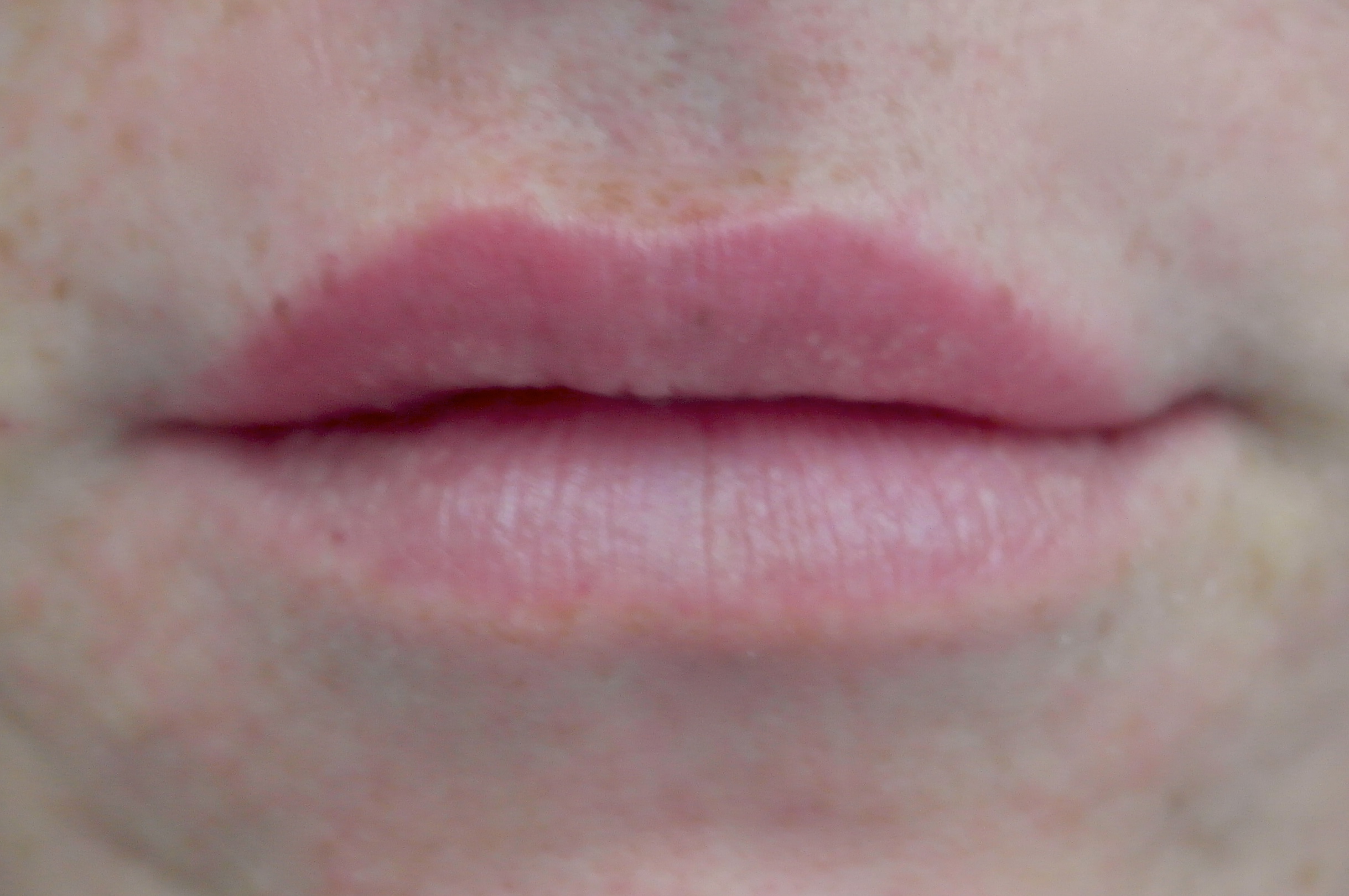Lip Augmentation - Fillers Before & After Patient #14842
