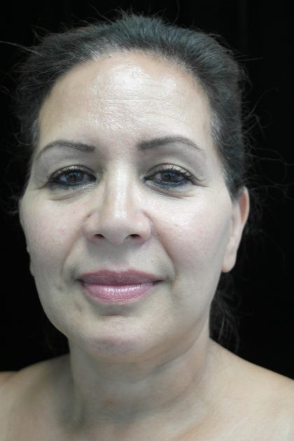 Chin Implants Before & After Patient #14806